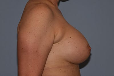 Breast Augmentation Before & After Gallery - Patient 204664 - Image 6