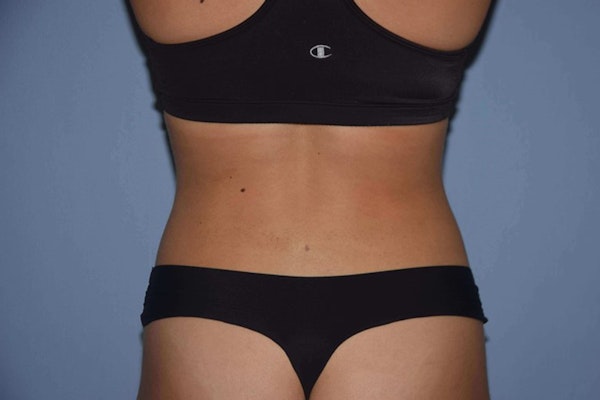 Liposuction Before & After Gallery - Patient 236211 - Image 4