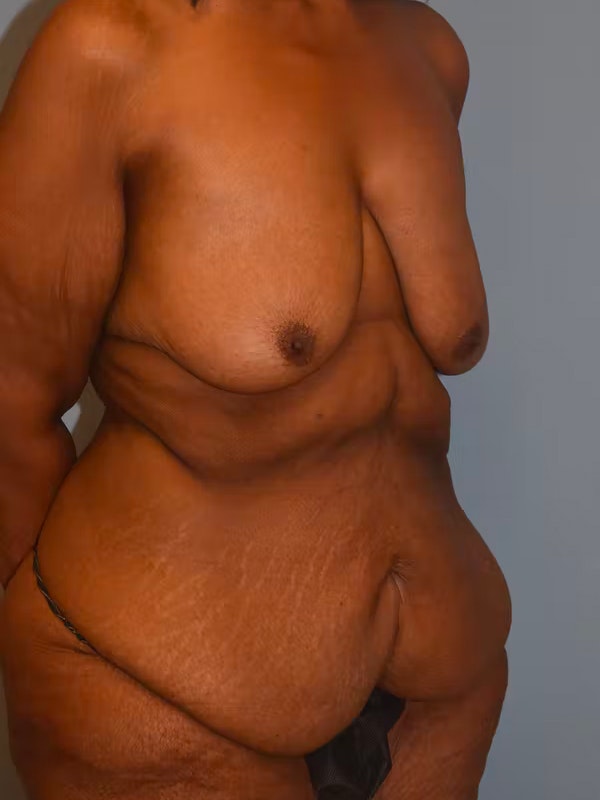 After Weight Loss Surgery Before & After Gallery - Patient 299389 - Image 3