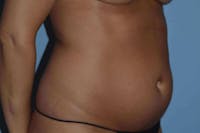 Liposuction Before & After Gallery - Patient 266529 - Image 1