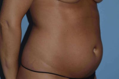 Liposuction Before & After Gallery - Patient 266529 - Image 1