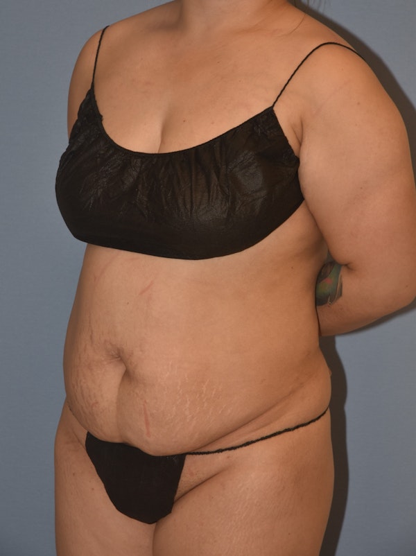Tummy Tuck Before & After Gallery - Patient 298423 - Image 3