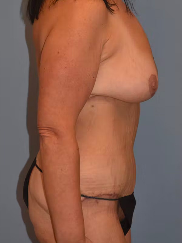 Mommy Makeover Before & After Gallery - Patient 400614 - Image 6