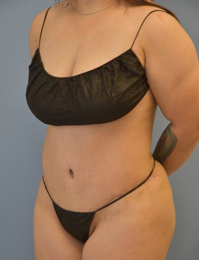 Tummy Tuck Before & After Gallery - Patient 298423 - Image 4
