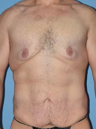 After Weight Loss Surgery Before & After Gallery - Patient 195173 - Image 1