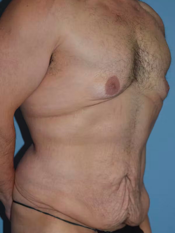 After Weight Loss Surgery Before & After Gallery - Patient 195173 - Image 3