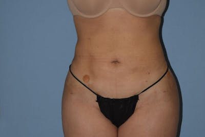 Liposuction Before & After Gallery - Patient 547843 - Image 2