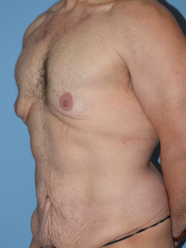 After Weight Loss Surgery Before & After Gallery - Patient 195173 - Image 5