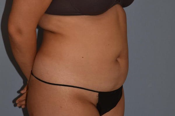 Liposuction Before & After Gallery - Patient 547843 - Image 3