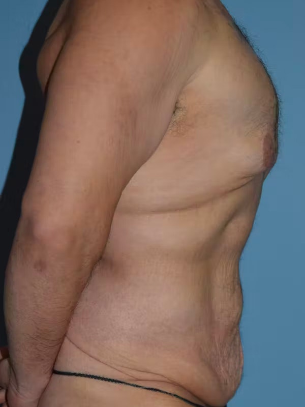 After Weight Loss Surgery Before & After Gallery - Patient 195173 - Image 7