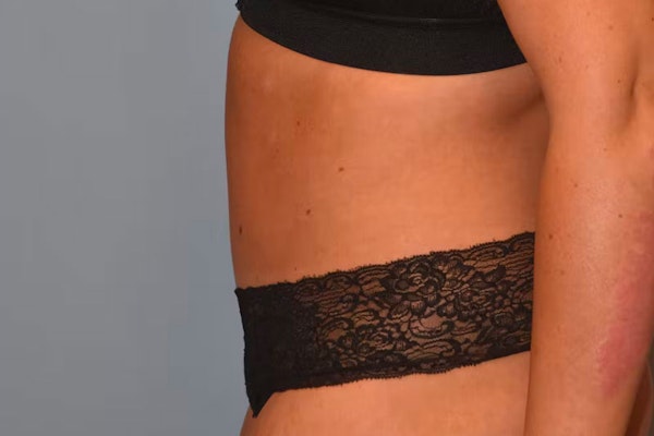Tummy Tuck Before & After Gallery - Patient 361139 - Image 8