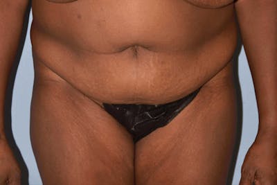 Liposuction Before & After Gallery - Patient 203610 - Image 1