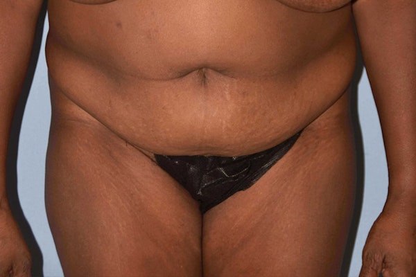 Liposuction Before & After Gallery - Patient 203610 - Image 1