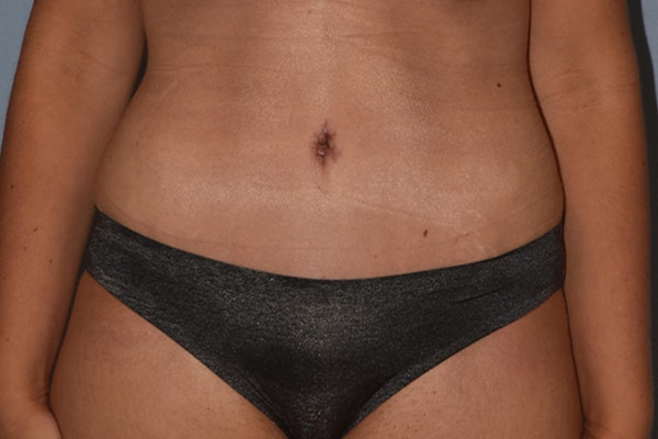 Tummy Tuck Before & After Gallery - Patient 236581 - Image 2