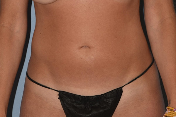 Liposuction Before & After Gallery - Patient 206605 - Image 1