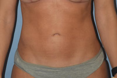 Liposuction Before & After Gallery - Patient 206605 - Image 2