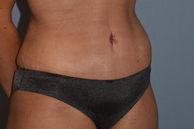 Tummy Tuck Before & After Gallery - Patient 236581 - Image 4