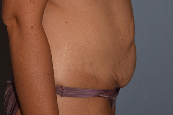 Tummy Tuck Before & After Gallery - Patient 236581 - Image 5