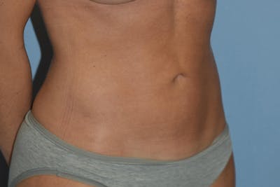 Liposuction Before & After Gallery - Patient 206605 - Image 4