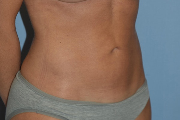 Liposuction Before & After Gallery - Patient 206605 - Image 4