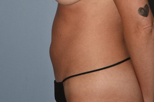 Liposuction Before & After Gallery - Patient 206605 - Image 7