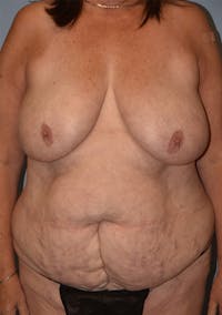 Mommy Makeover Before & After Gallery - Patient 155279 - Image 1
