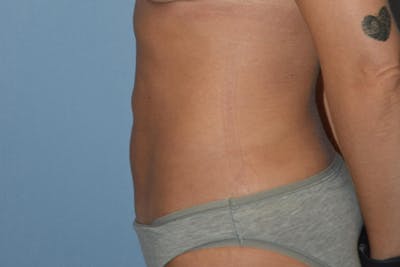 Liposuction Before & After Gallery - Patient 206605 - Image 8