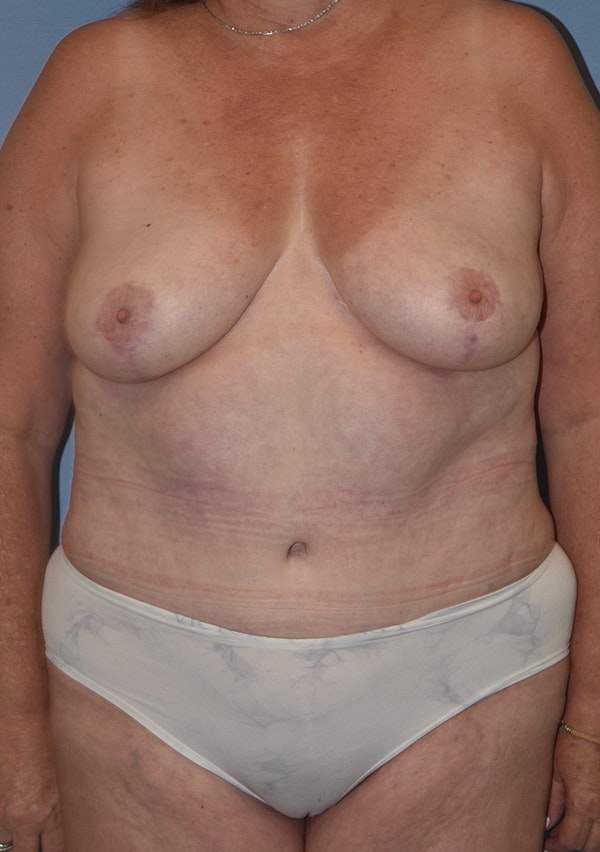 Mommy Makeover Before & After Gallery - Patient 155279 - Image 2