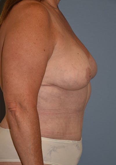 Mommy Makeover Before & After Gallery - Patient 155279 - Image 6
