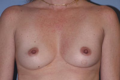 Breast Augmentation Before & After Gallery - Patient 235074 - Image 1