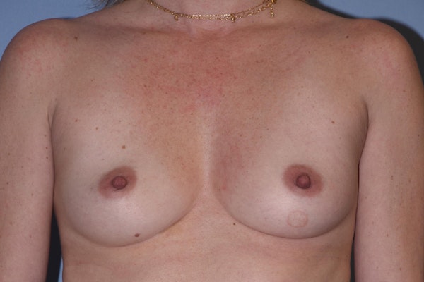 Breast Augmentation Before & After Gallery - Patient 235074 - Image 1