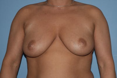 Breast Augmentation Before & After Gallery - Patient 199018 - Image 1