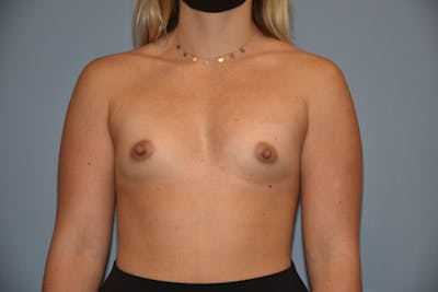 Breast Augmentation Before & After Gallery - Patient 144636 - Image 1