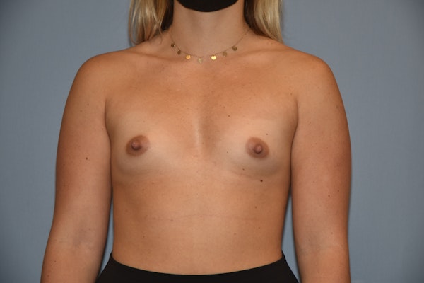 Breast Augmentation Before & After Gallery - Patient 144636 - Image 1