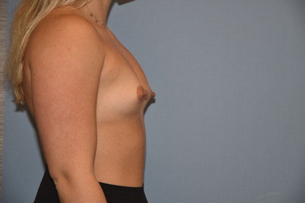Breast Augmentation Before & After Gallery - Patient 144636 - Image 5