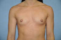 Breast Augmentation Before & After Gallery - Patient 397890 - Image 1