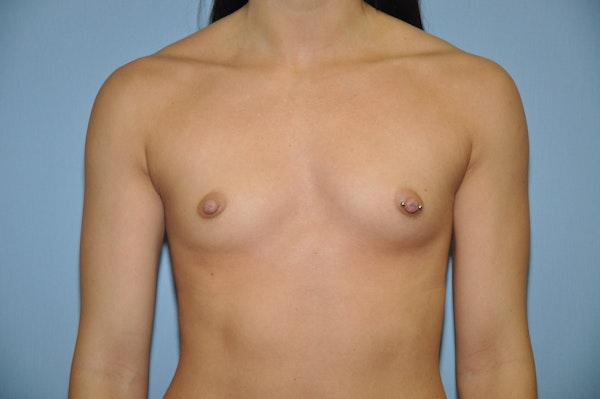 Breast Augmentation Before & After Gallery - Patient 397890 - Image 1