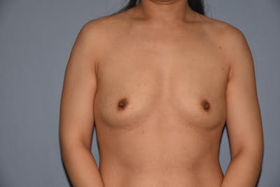 Breast Augmentation Before & After Gallery - Patient 372953 - Image 1