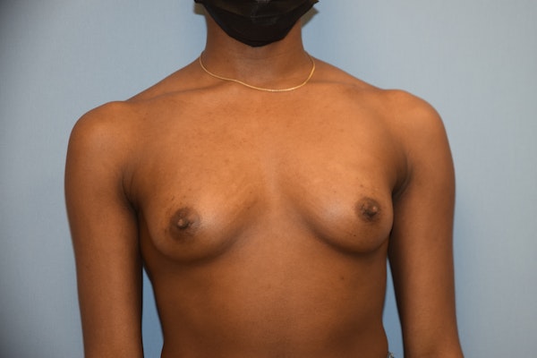 Breast Augmentation Before & After Gallery - Patient 307277 - Image 1