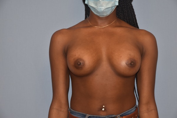 Breast Augmentation Before & After Gallery - Patient 307277 - Image 2