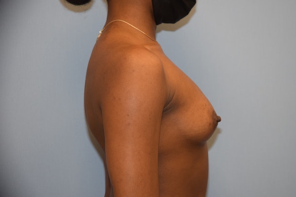 Breast Augmentation Before & After Gallery - Patient 307277 - Image 5