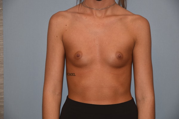 Breast Augmentation Before & After Gallery - Patient 245636 - Image 1