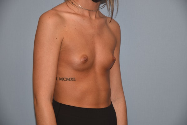 Breast Augmentation Before & After Gallery - Patient 245636 - Image 3