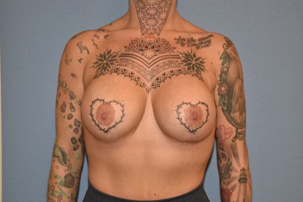 Breast Augmentation Before & After Gallery - Patient 773789 - Image 2