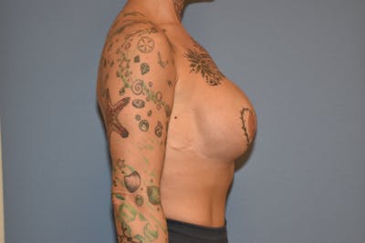 Breast Augmentation Before & After Gallery - Patient 773789 - Image 6