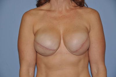 Breast Reconstruction Before & After Gallery - Patient 192679 - Image 1