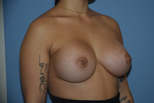 Breast Augmentation Before & After Gallery - Patient 412565 - Image 6