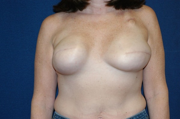 Breast Reconstruction Before & After Gallery - Patient 402683 - Image 1
