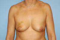 Breast Reconstruction Before & After Gallery - Patient 178249 - Image 1