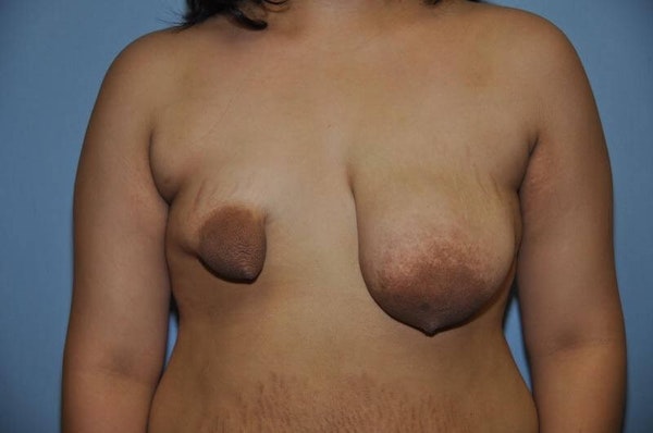 Breast Reconstruction Before & After Gallery - Patient 428425 - Image 1